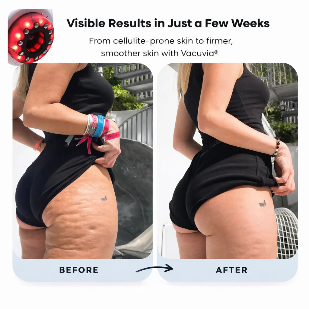 Anti-Cellulite Massager